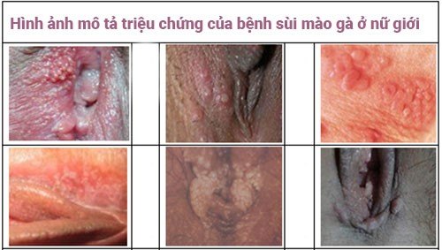 triệu chứng bệnh sùi mào gà ở bộ phận sinh dục nữ giới