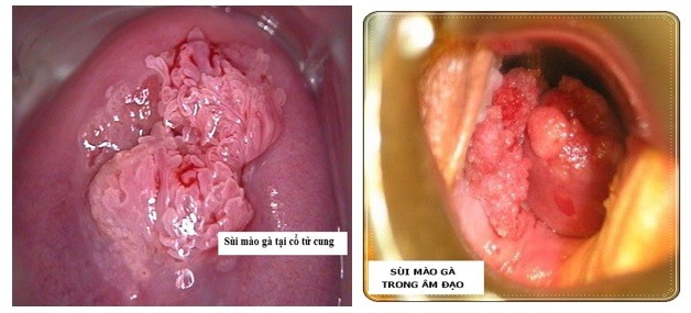 hình ảnh sùi mào gà tại cổ tử cung và bên trong âm đạo