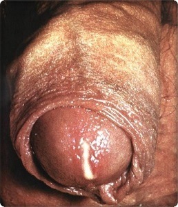 hình ảnh bệnh lậu ở bộ phận sinh dục nam