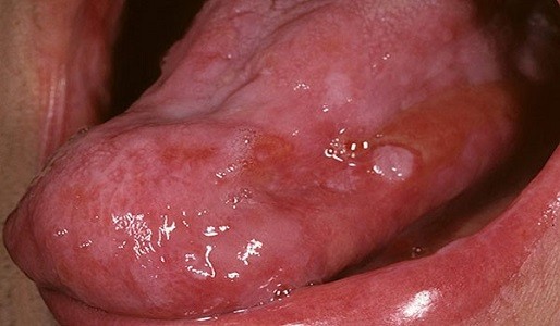 hình ảnh bệnh lậu ở lưỡi