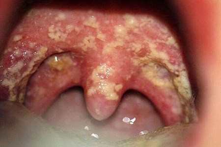 hình ảnh bệnh lậu ở trong miệng