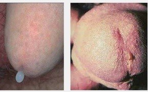 hình ảnh giọt mủ ban mai dấu hiệu của bệnh lậu