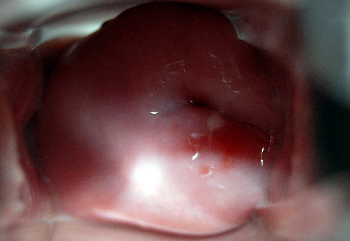 hình ảnh sùi mào gà ở cổ tử cung giai đoạn đầu