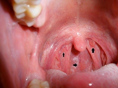 triệu chứng bệnh sùi mào gà ở miệng giai đoạn đầu