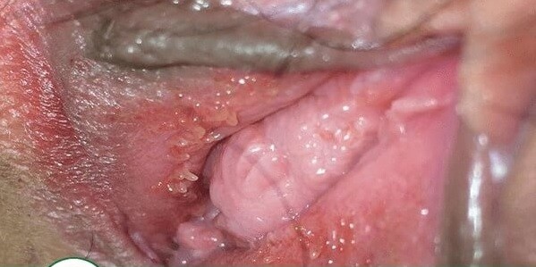triệu chứng bệnh sùi mào gà ở nữ giới giai đoạn đầu