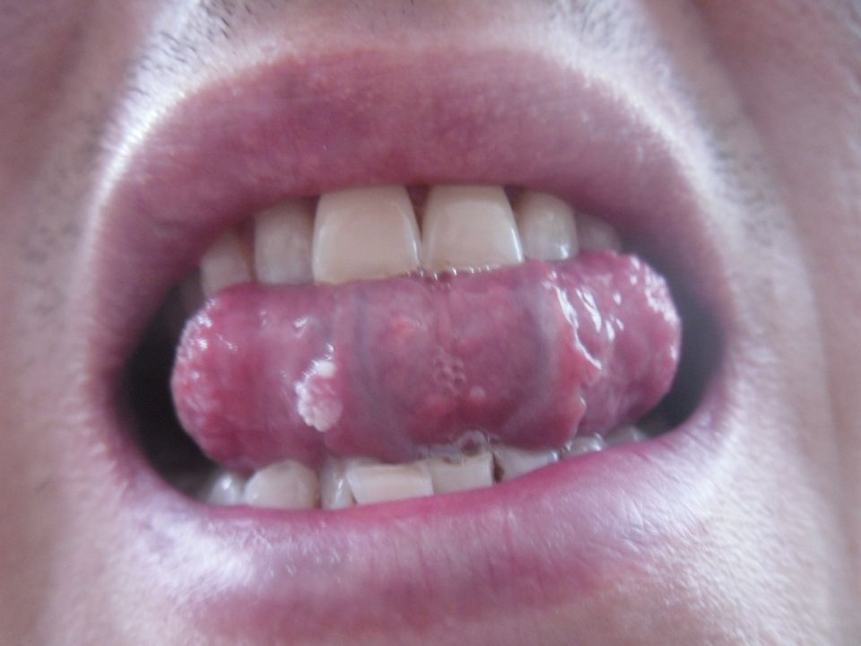 hình ảnh bệnh sùi mào gà trường hợp mọc dưới lưỡi