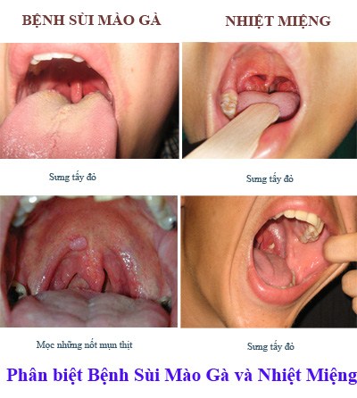 phân biệt triệu chứng bệnh sùi mào gà ở miệng và bệnh nhiệt miệng